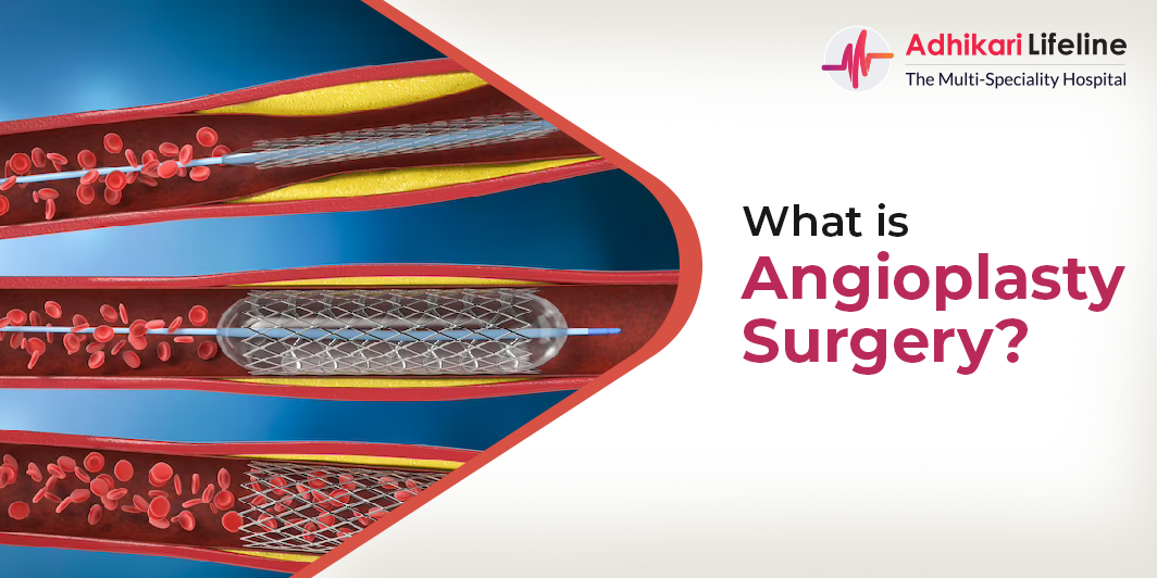 Everything You Need to Know About Angioplasty - Adhikari Lifeline